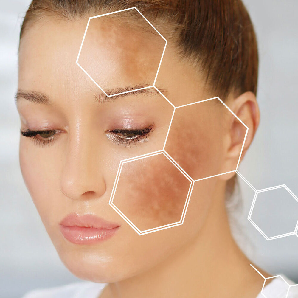 cosmelan behandeling zoetermeer cosmelan 2 melan recovery melan 130 pigment control zwangerschapsmasker melasma pih post inflammatoire hyperpigmentatie zonnevlekken ouderdomsvlekken huidtherapie
