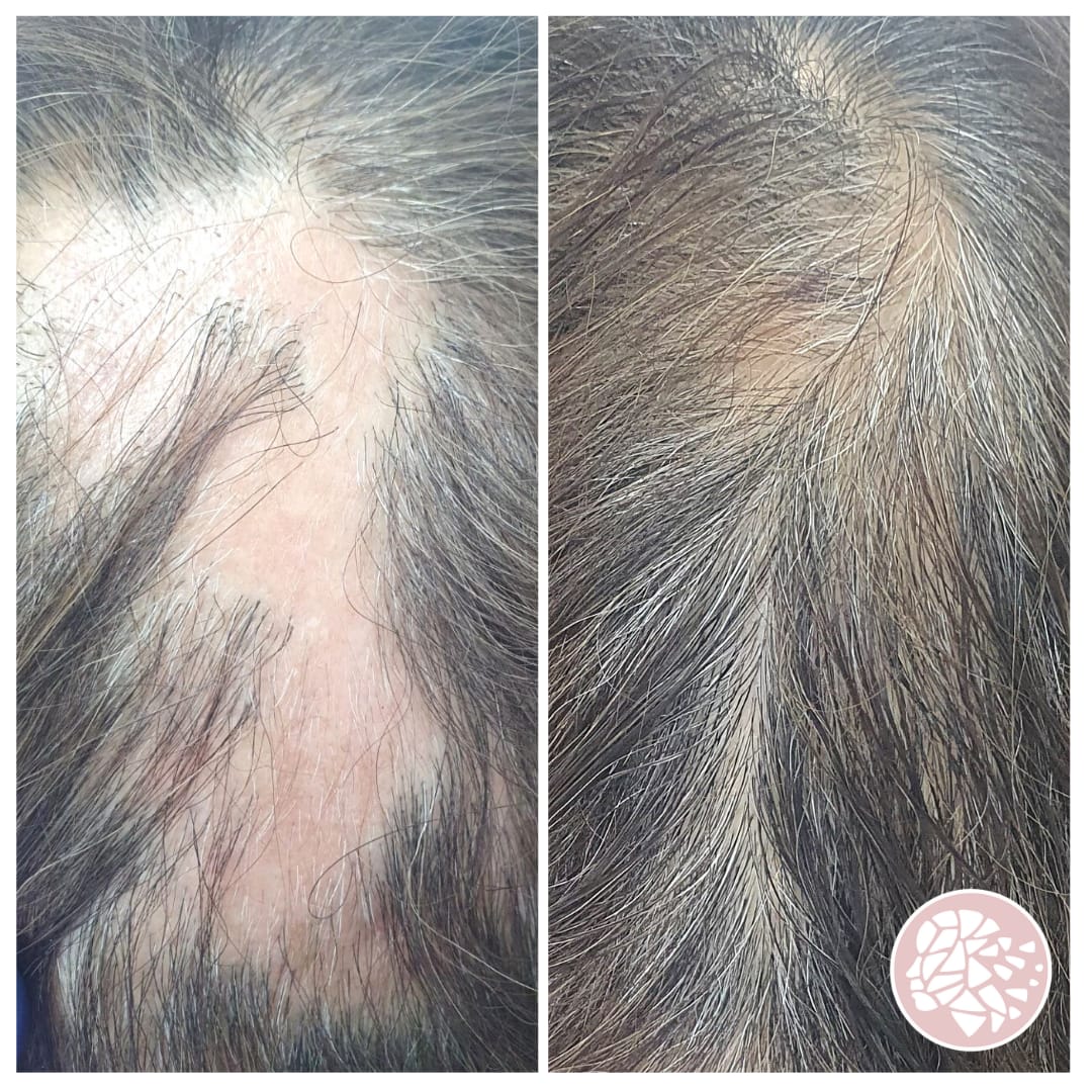 alopecia behandeling haaruitval haarverlies alopecia areata alopecia androgenetica vrouw oorzaak therapie zoetermeer mesotherapie mesohair microneedling