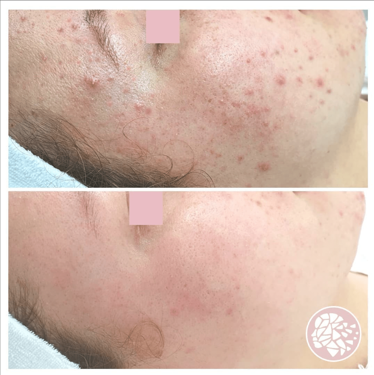 acne voor en na foto, acnebehandeling, acnetherapie, acnetherapy, puistjes, jeugdpuistjes, acnelittkens, ontstekingen, gezichtsbehandeling, peeling, maas huidtherapie