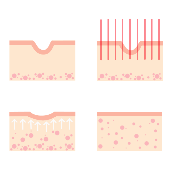 fractionele laser werking, anatomie, fractional laser anatomy, maas huidterapie zoetermeer, den haag, rotterdam, huidverstrakking, anti-aging, acnelittekens, littekens, striae