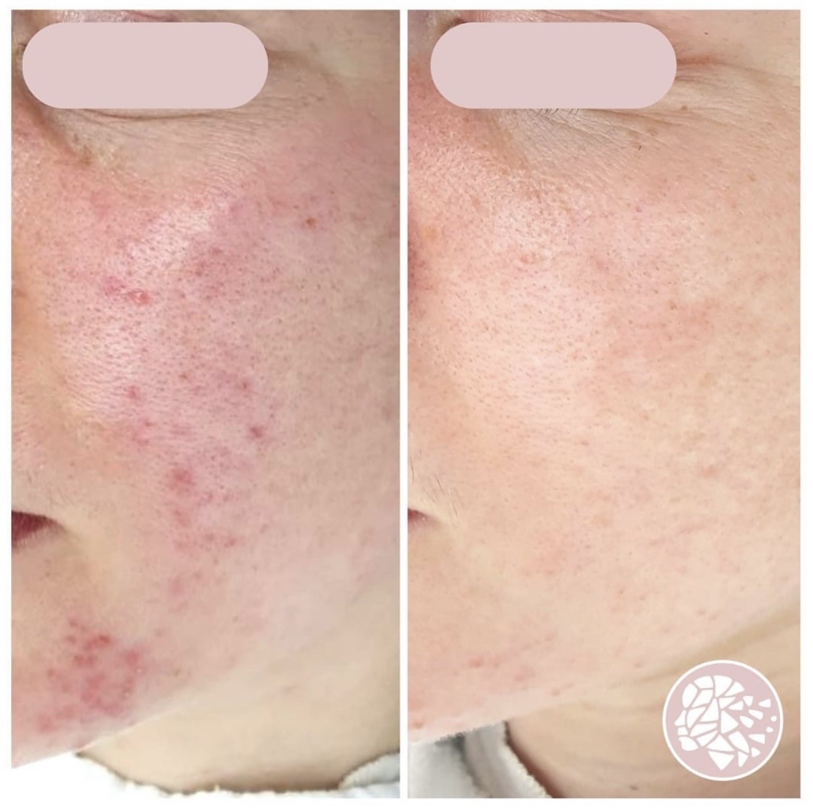 acnebehandeling, behandeling tegen acne, maas huidtherapie, zoetermeer, acnetherapie vergoeding, acne peeling, acne gezicht, acne rug, acne borst, jeugdpuistjes, peeling, peeling gezicht, biopeeling, fruitzuur peeling, peeling rosacea
