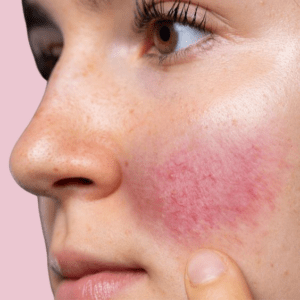 rosacea, rode wangen, roodheid gezicht, toleriane, rosaliac, la roche-posay, producten tegen roodheid, product om roodheid te verminderen,