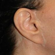 littekens na een facelift, litteken facelift, litteken neklift, litteken naast oor, litteken achter oor, dik litteken na facelift, wit litteken na facelift, litteken facelift behandeling, hersteltijd na facelift, litteken behandeling, maas huidtherapie, zoetermeer