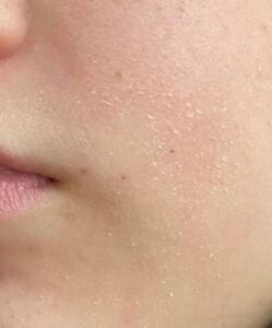 dry skin, droge huid, droge huid winter, winterhuid, velletjes rond neus, vochtarme huid, vochtverlies huid, droge huid skin care, droge huid huidverzorging, droge huid verzorgen, behandeling droge huid, rode droge huid gezicht, droge huid lichaam, droge huid armen, droge huid benen, droge lippen