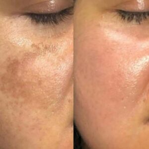 melasma, tips, behandeling, melasma gezicht, melasma na zwangerschap, donkere vlekken na zwangerschap, donkere vlekken gezicht, pigmentvlekken gezicht, pigmentvlekken na zwangerschap, pigmentvlekken borstvoeding, pigmentvlekken hormonen, pigmentvlekken behandeling, melasma huidverzorging, melasma skin care, melasma tips, melasma huidtherapie, maas huidtherapie, zoetermeer