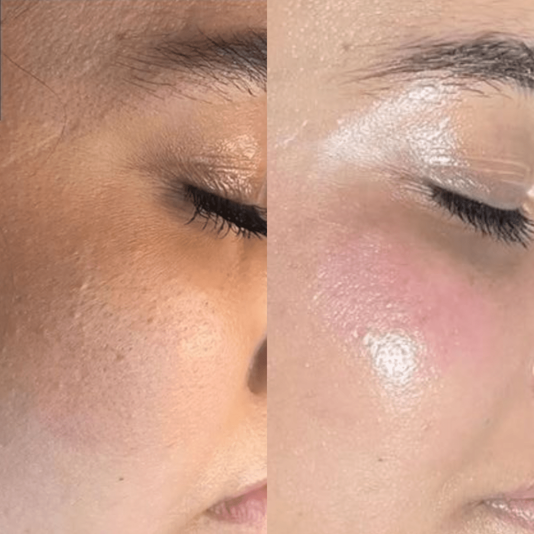 voor en na foto peeling, chemische peeling zoetermeer, peeling behandeling zoetermeer, huidtherapeut zoetermeer, peeling vergoeding, peeling tegen rimpels, chemische peeling rotterdam, peeling huidtherapie, peeling vergoeding zorgverzekeraar