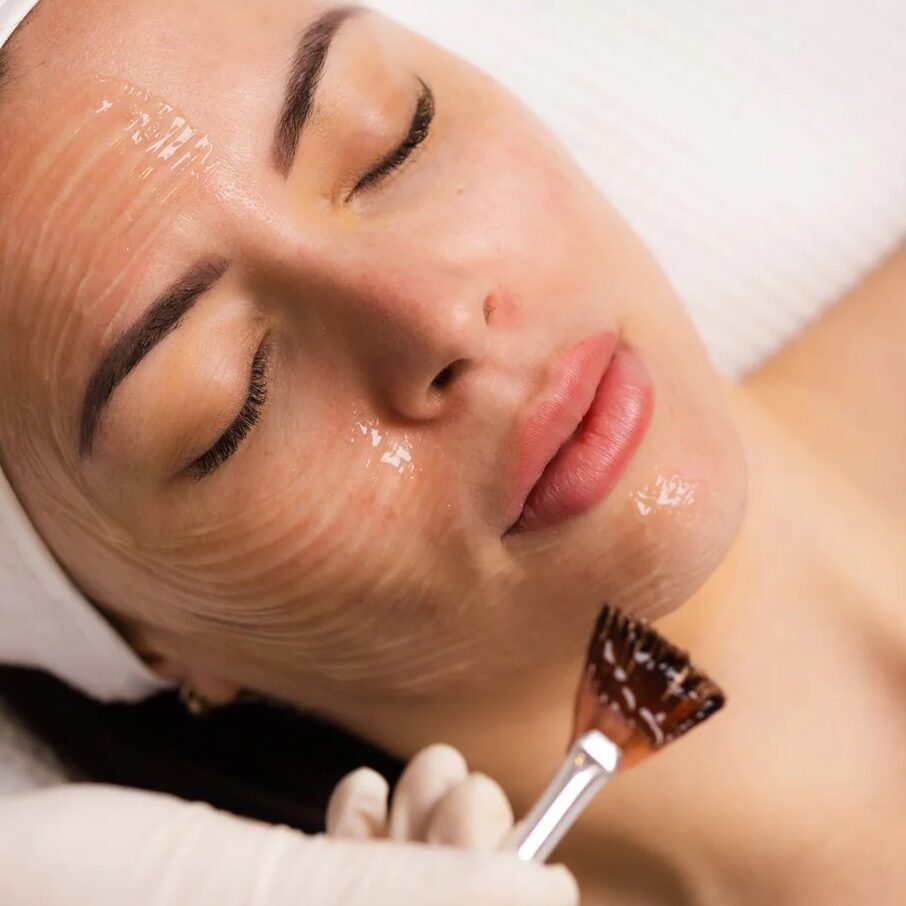 chemische peeling zoetermeer, peeling behandeling zoetermeer, huidtherapeut zoetermeer, peeling vergoeding, peeling tegen rimpels, chemische peeling rotterdam, peeling huidtherapie, peeling vergoeding zorgverzekeraar