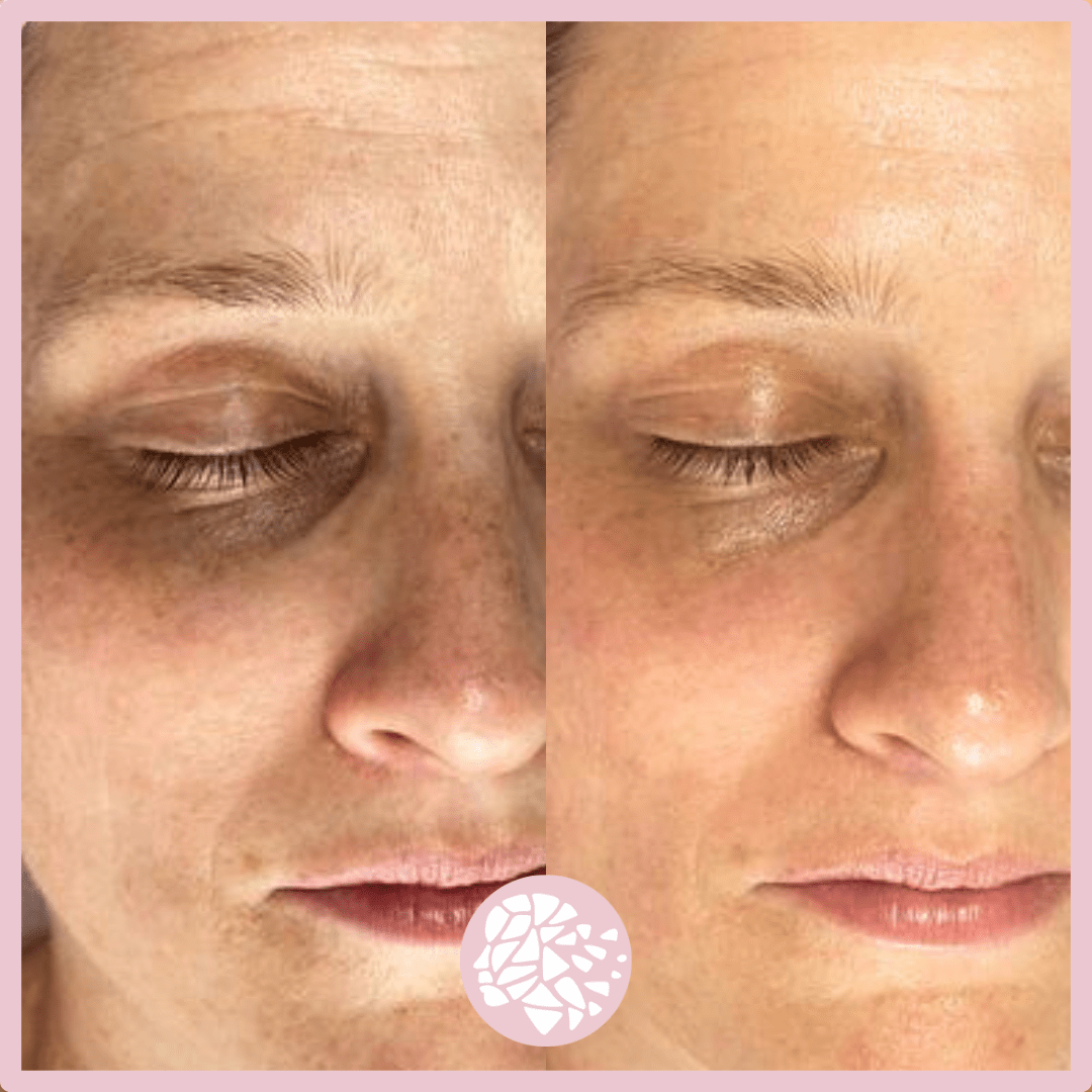 mesotherapie, skinbooster zoetermeer, skinbooster maas huidtherapie, skinbooster gezicht, mesotherapie gezicht, mesotherapie ogen, mesotherapie donkere kringen, mesobehandeling, vergoeding mesotherapie, mesotherapie huidtherapie,