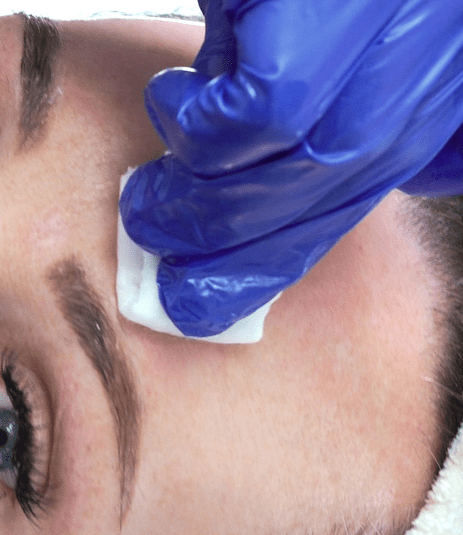 tca peeling, tca peeling behandeling, tca peel treatment, tca cross, tca littekens, tca rimpels, rimpelbehandeling, anti-aging behandeling, grove huid behandeling, grote poriën behandeling, zoetermeer, maas huidtherapie tca peeling