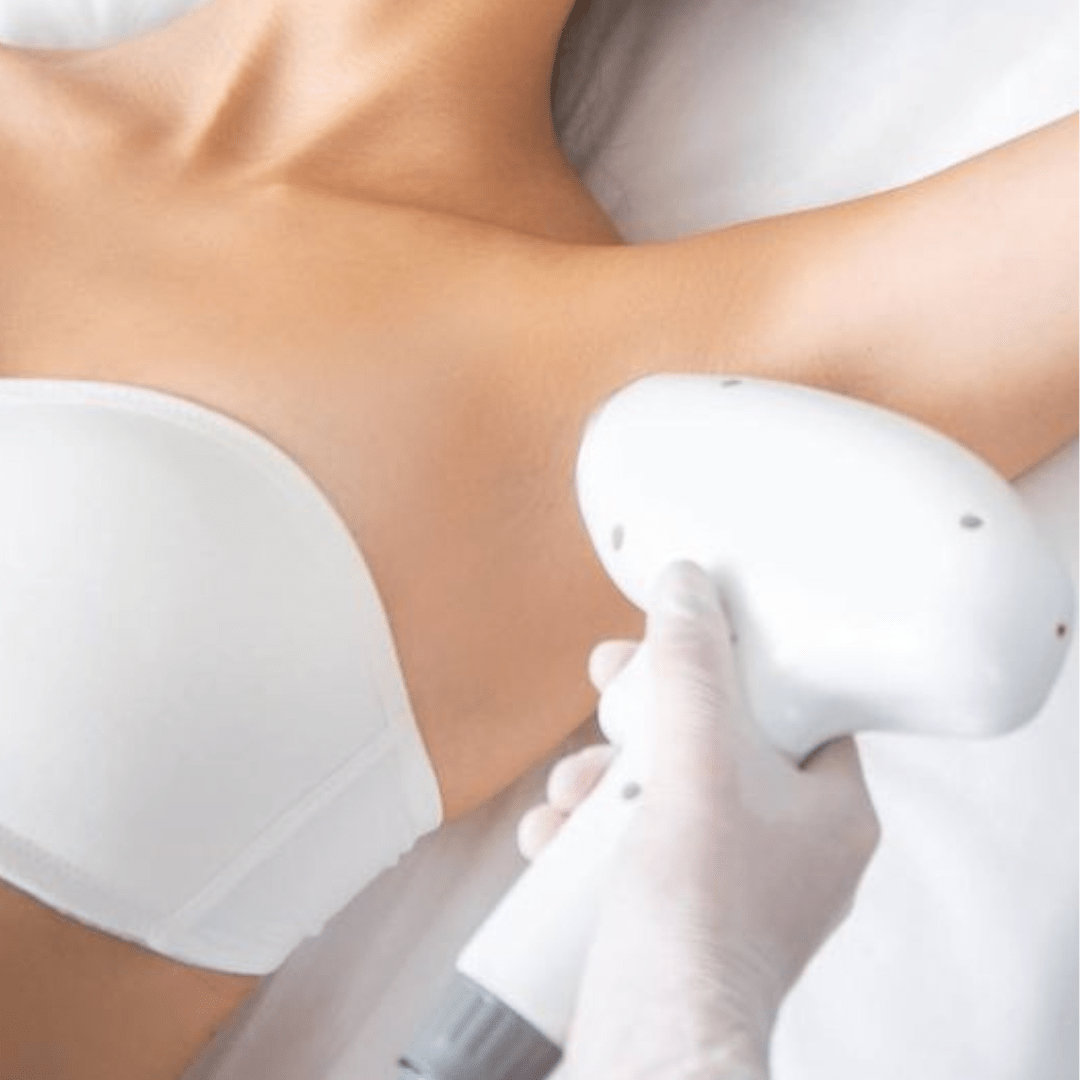 laserontharing laserontharen lichaam zoetermeer maas huidtherapie