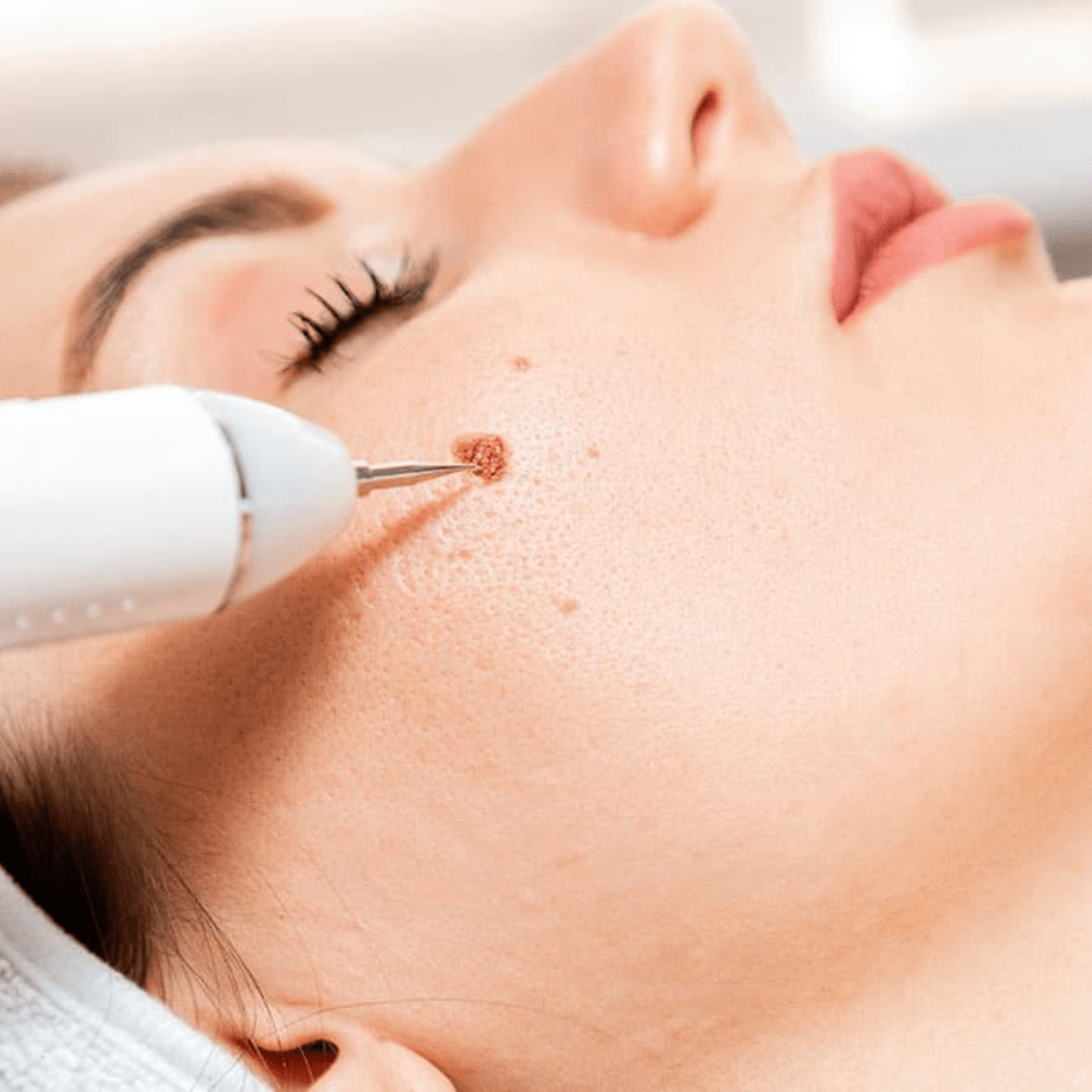 coagulatie wegbranden wratten, wratjes verwijderen, steelwratjes verwijderen, bultjes verwijderen, bultjes wegrbanden zoetermeer, maas huidtherapie