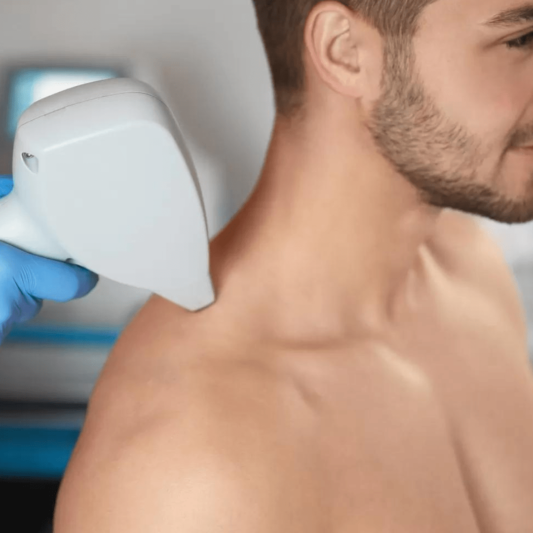 laserontharing bij mannen, laserontharen mannen, rug laseren, borst laseren, schouders laseren, buik laseren, baard laseren, baardcontour laseren, mannen behandeling zoetmeer, maas huidtherapie