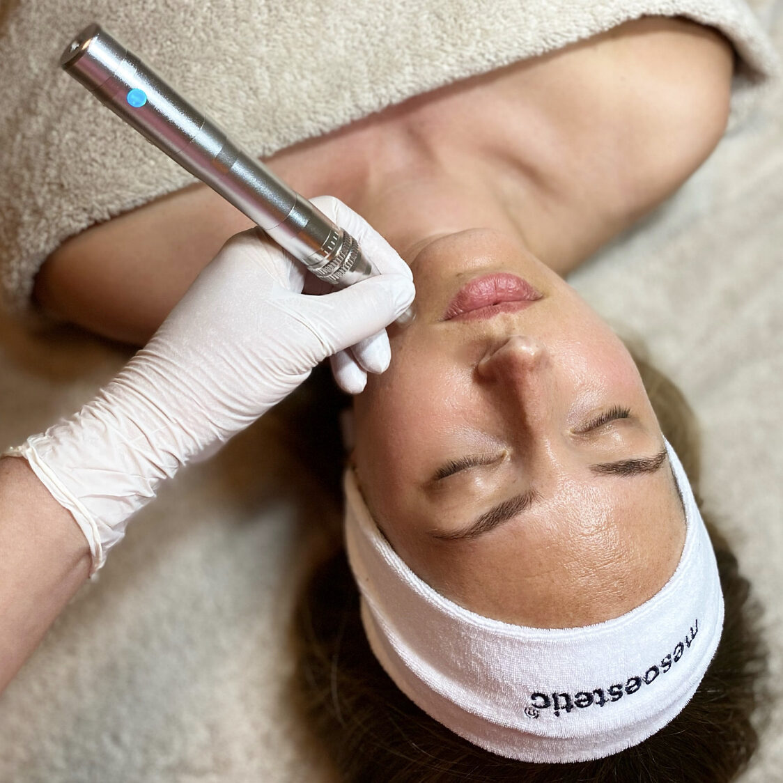 mesoestetic, microneedling, mpen, dermapen 5, dermapen 5 zoetermeer, microneedling zoetermeer, micro needling zoetermeer