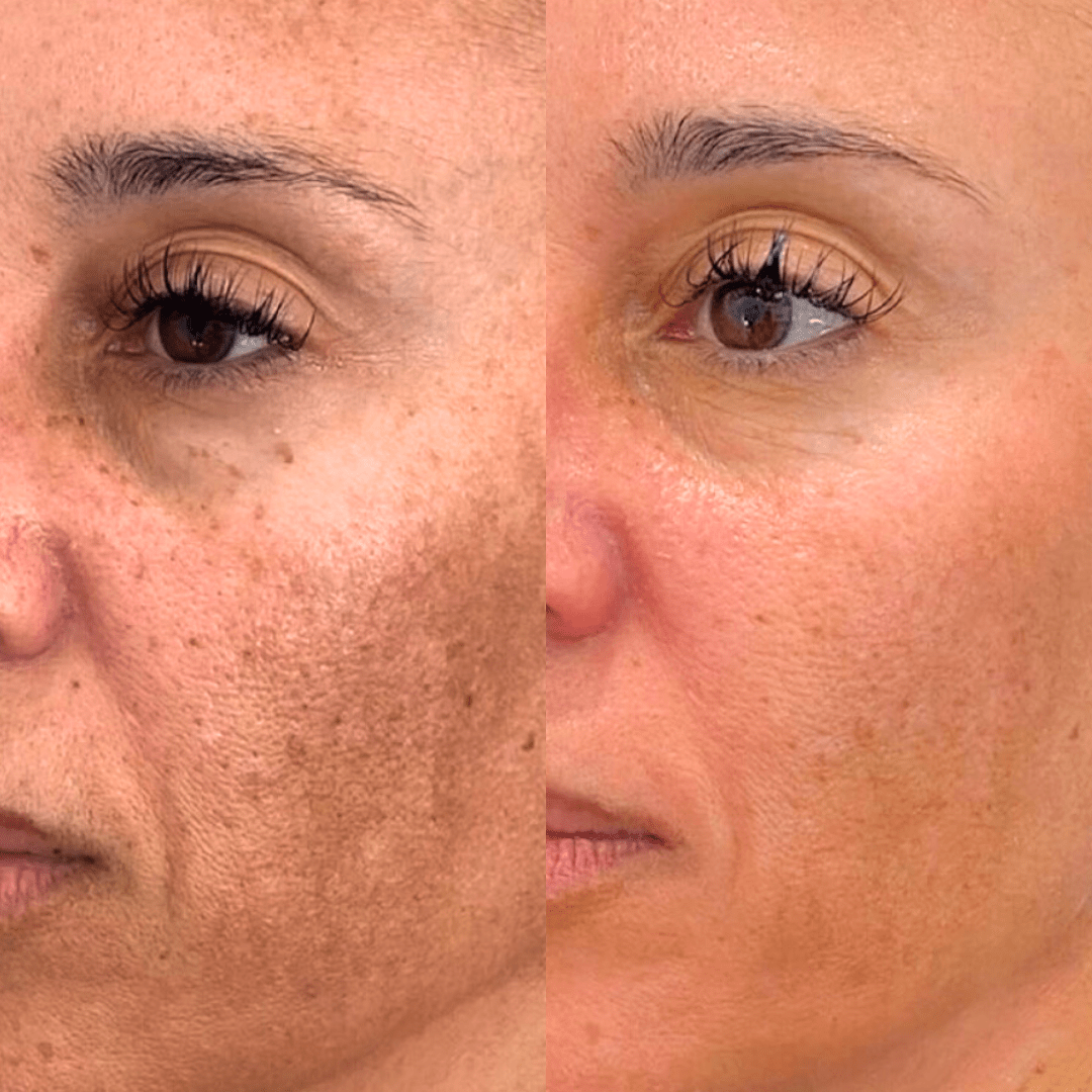 dermamelan behandeling, dermamelan zoetermeer, pigmentvlekken verwijderen zoetermeer, pigmentvlekken behandelen zoetermeer, dermamelan pijnacker, cosmelan pijnacker, dermamelan kliniek, dermamelan bestellen