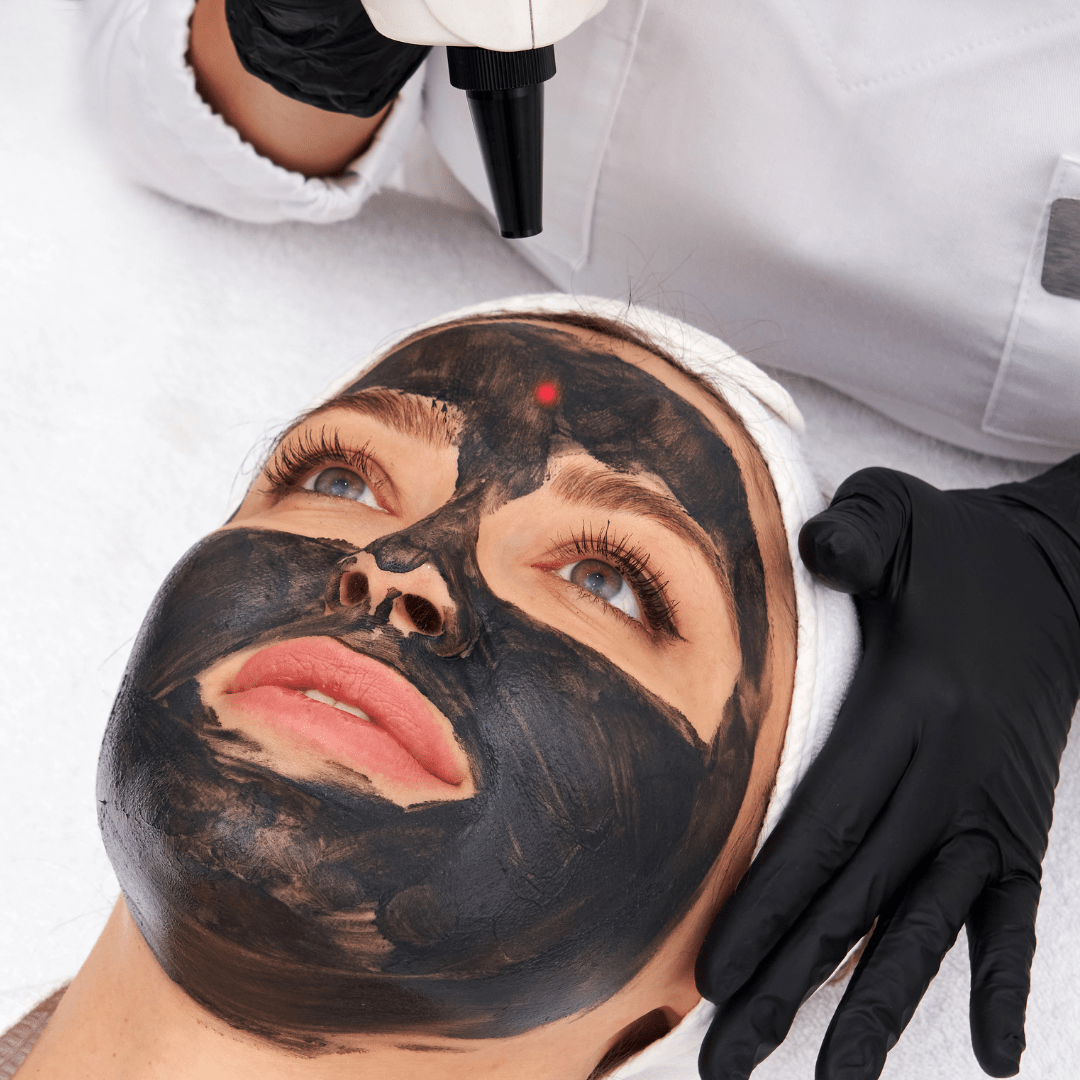 carbon laser peel, carbon laser peeling, carbon laser, carbon laser behandeling, co2 laser, carbon peeling, carbon behandeling, laserbehandeling carbon, carbon laser zoetermeer, carbon laser maas huidtherapie