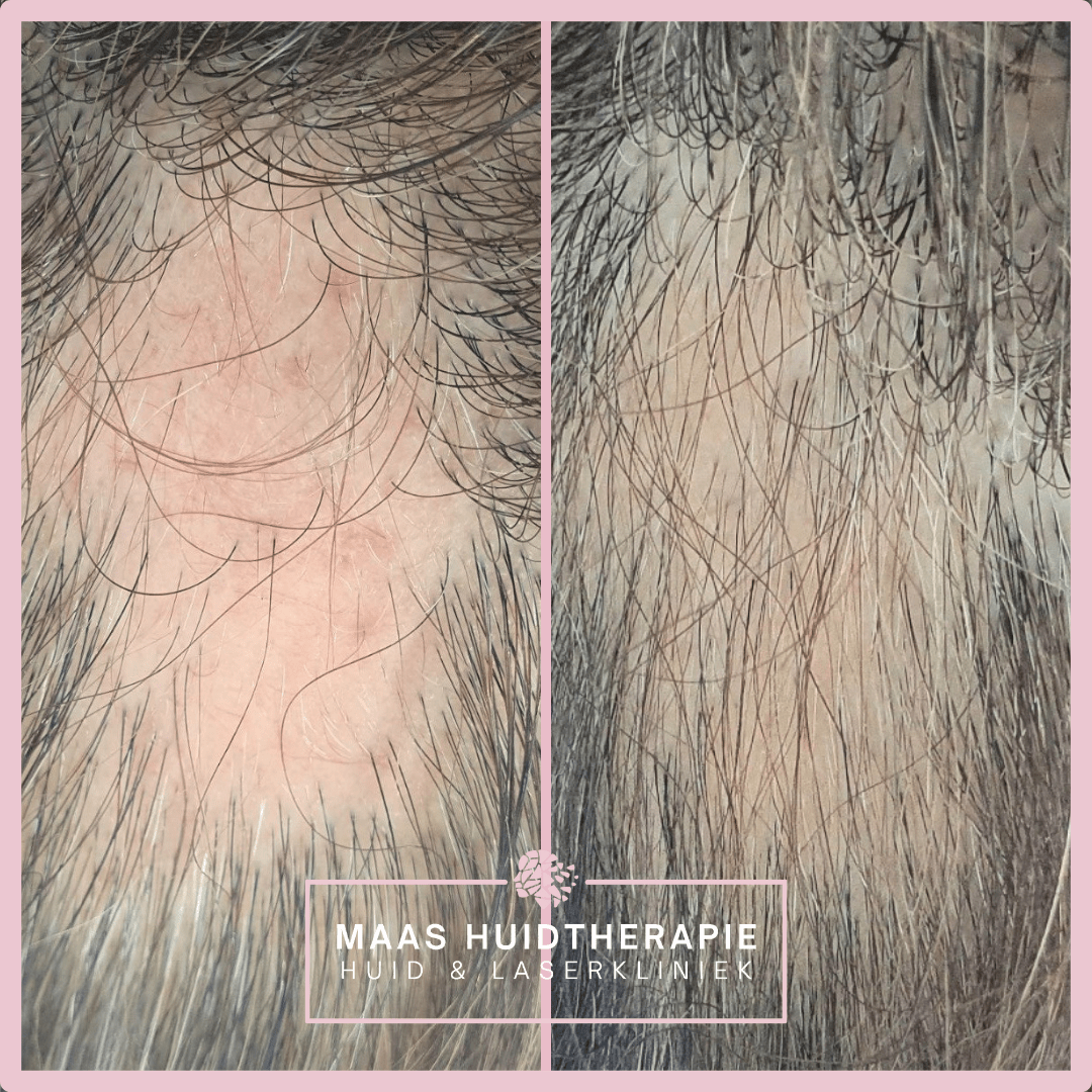 voor en na haaruitval behandeling, behandeling tegen alopecia areata, alopecia areata haargroei, haargroeistimulatie, stimulatie haargroei