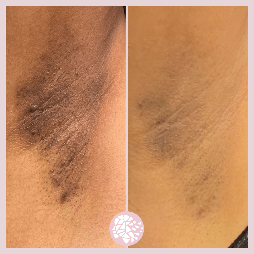 dermamelan intimate behandeling, donkere oksels, donkere vagina, donkere bikinilijn, donkere huid onder oksels, schaamstreek bleken, donkere schaamstreek na zwangerschap, maas huidtherapie, vajacial, pigmentbehandeling
