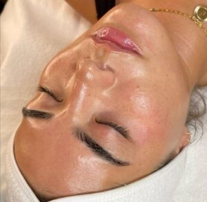 hydrafacial zoetermeer, hydrafacial behandeling, hydrafacial prijs, hydrafacial werking, hydradermabrasie, hydra behandeling, hydro behandeling, hydra dieptereiniging, dieptereiniging behandeling, dieptereiniging gezicht, hydrafacial vergoeding, hydrafacial maas huidtherapi