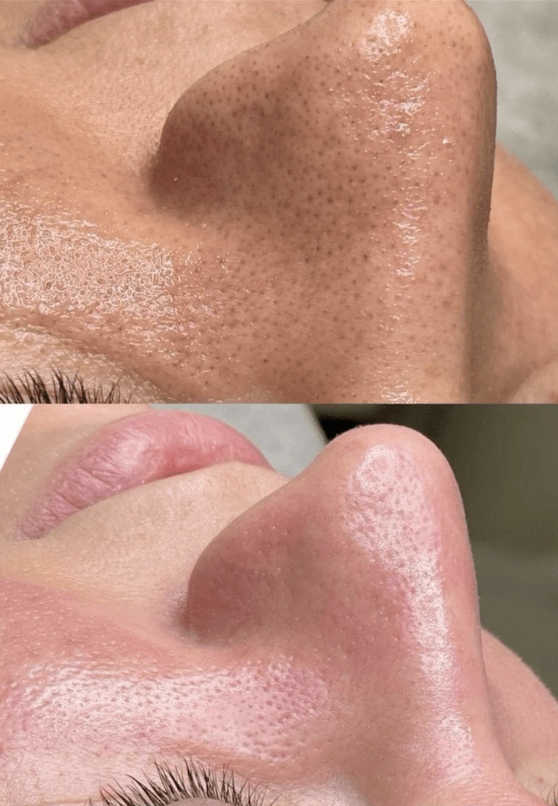 hydrafacial voor en na, hydrafacial before after, hydrafacial werking, hoe ziet je huid eruit na hydrafacial, hydrafacial zoetermeer, hydrafacial dieptereiniging, hydra facial