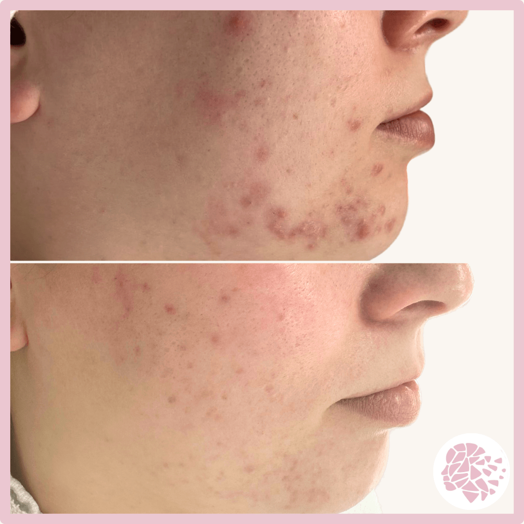 acne voor en na foto, acnebehandeling, acnetherapie, acnetherapy, puistjes, jeugdpuistjes, acnelittkens, ontstekingen, gezichtsbehandeling, peeling, maas huidtherapie, behandeling voor acne, acne behandeltraject, acne resultaten,