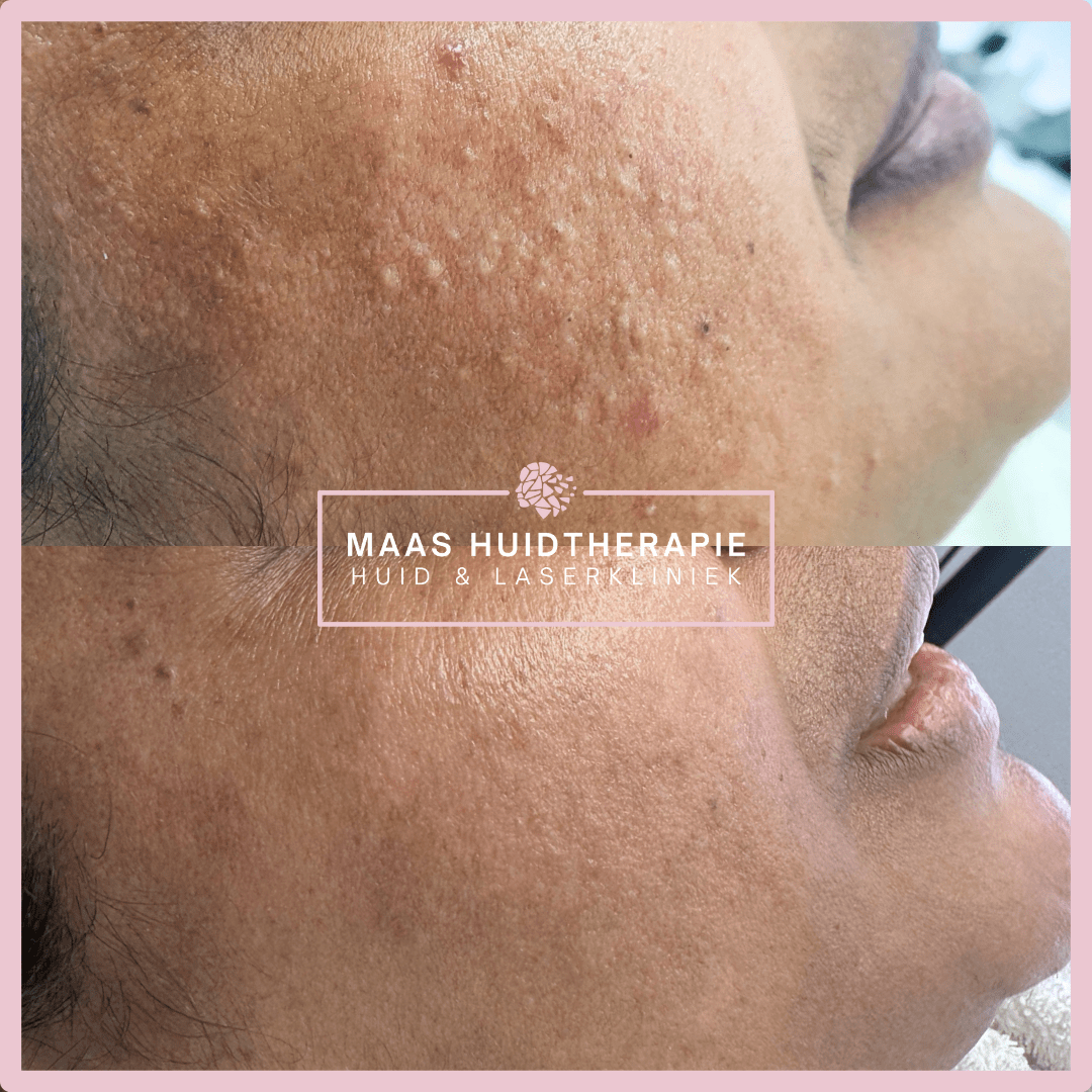 acne voor en na foto, acnebehandeling, acnetherapie, acnetherapy, puistjes, jeugdpuistjes, acnelittkens, ontstekingen, gezichtsbehandeling, peeling, maas huidtherapie, behandeling voor acne, acne behandeltraject, acne resultaten, acne donkere huid behandeling