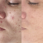 peeling before and after, chemical peel, chemische peeling, amandelzuur, salicylzuur, glycolzuur, blemiskin, mesopeel, tca peeling, tca peel, zoetermeer, pijnacker, maas huidtherapie, voor en na een huidbehandeling, vlekjes na acne, peeling voor acne, peeling voor puistjes,