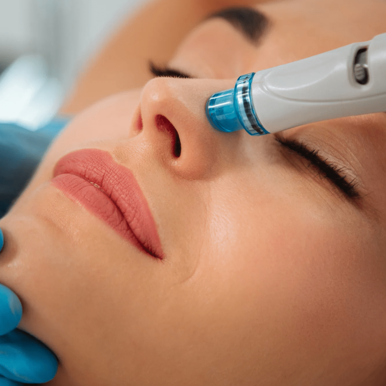 hydrafacial, hydrapeeling, hydromicrodermabrasie, hydramicrodermabrasie, microdermabrasie, hydratatie behandeling, behandeling voor hydratatie, zoetermeer, hydraterende gezichtsbehandeling, behandeling droge huid, huidkliniek hydrafacial