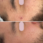 behandeling voor acnelittkens, acne behandeling, acnelittekens behandeling, littekenbehandeling acne, acnetherapie zoetermeer