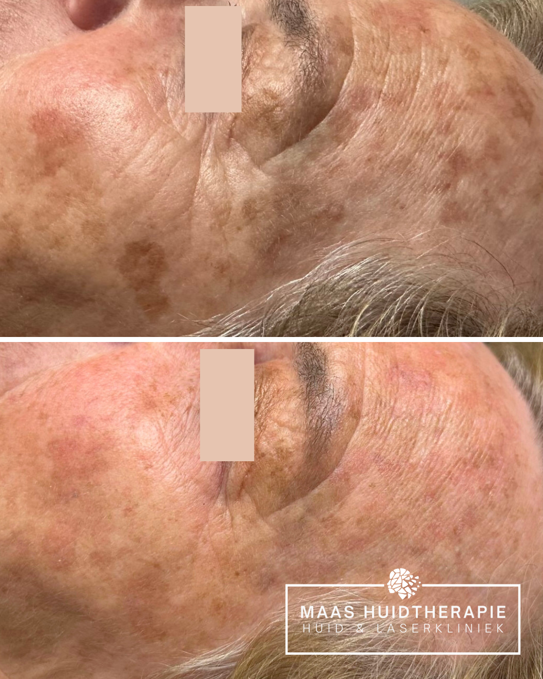 before after pigmentvlekken, pigmentvlekken behandeling, pigmentvlek behandeling, pigmentkiller, pigmentlaser, picolaser pigmentvlekken, pico laser, pico pigment, ouderdomsvlekken behandelen, zonschade laser