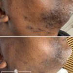 voor en na folliculitis barbae, folliculitis barbae, ingegroeide baardharen, laseren baard, laser baardcontour, acne baard, donkere huid laseren, huidbehandeling donkere huid, dark skin laser hair removal, dark skin ingrown hairs, keloid dark skin