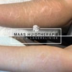 behandeling automutilatie littekens, automutilatie littekens, littekens snijden armen, littekens van snijden, automutilatie behandeling, littekenbehandeling voor en na, littekenbehandeling, automutilation scars, automutilation scars treatment, tca cross, fractional laser, microneedling scars, microneedling littekens, fractionele laser littekens