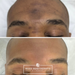 pigmentvlekken bij mannen, pigmentvlekken bij donkere huiden, behandeling pigmentvlek donkere huid, hyperpigmentatie donkere huid, dermamelan, cosmelan voor en na foto behandeling masker donkere huid dark skin maas huidtherapie hyperpigmentation pih melasma zwangerschapsmasker cosmelan 2, pigment , melan recovery, melan 130 pigment control