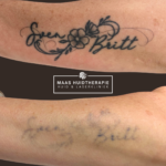 during tattoo removal, tattoo removal results, tattoo fading, tattoo before after, before after, voor en na tatoeage, tatoeage verwijderen, tatoeage laser, tattoo pico results, tattoo removal progress, partial tattoo removal