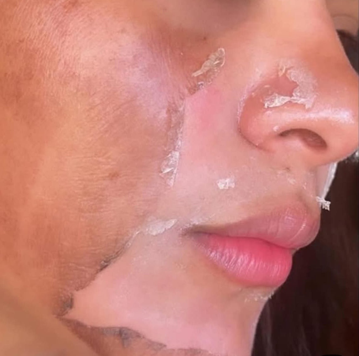 vervelling na tca peeling, skin peeling, peeling skin after chemical peel, chemical peel, chemische peeling, peeling zoetermeer, tca peeling zoetermeer, tca peel, tca peeling resultaten, tca vervelling, dead skin removal, huidvernieuwing, huidbehandeling, intensieve huidbehandeling, huidverbetering zoetermeer, schoonheidssalon zoetermeer