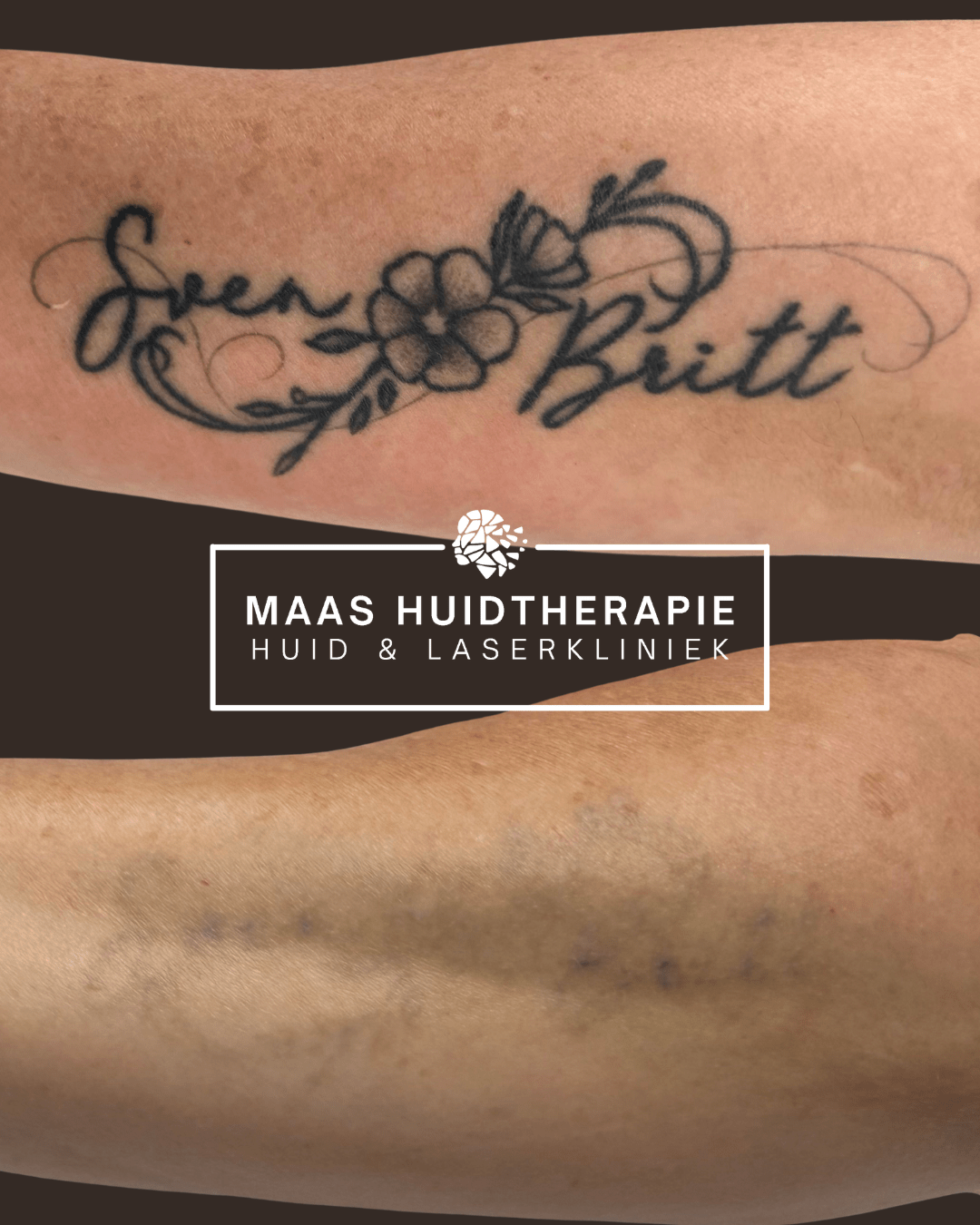 tatoeage verwijderen zoetermeer, tattoo verwijderen, tattoo laseren, tatoeage laseren, pico laser tattoo, pico laser tatoeage, tatoeage voor en na, tattoo voor en na
