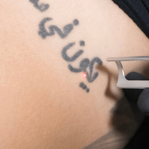 8 tatoeage verwijderen zoetermeer, tatoeage laten verwijderen, tatoeage laser zoetermeer, pico laser tatoeage, laser voor tatoeage, tatoeage laseren zoetermeer, tatoeage weglaseren, tattoo laseren, tattoo weglaseren zoetermeer