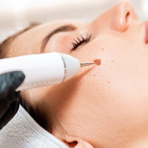 elektro-coagulatie coagulatietherapie electrocoagulatie elektrocoagulatie zoetermeer huidtherapie vergoeding declaratie dermatosis papulosa nigra steelwratjes wratten wrat verwijderen huidoneffenheden bultjes gerstekorrels milia milium, coagulatie, wratten verwijderen, wratten behandeling, bultjes verwijderen